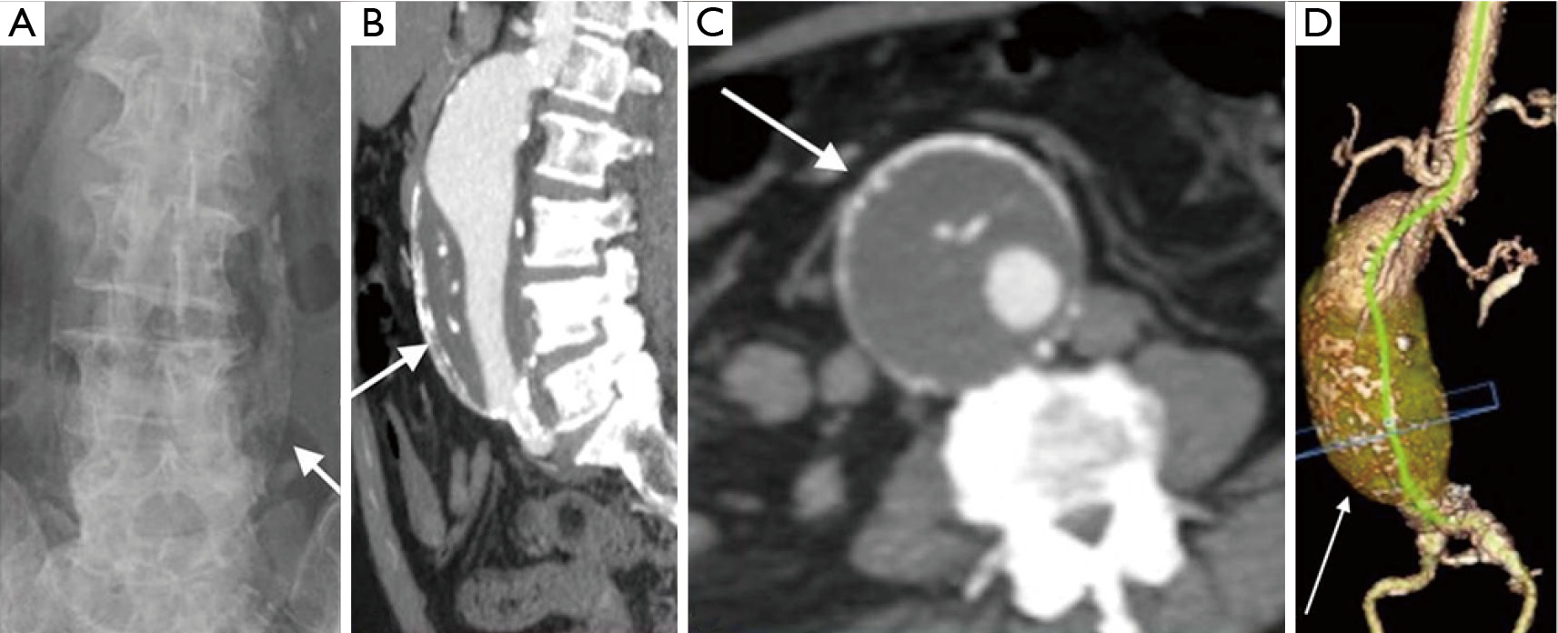 Abdominal Aortic Aneurysm Pictorial Review Of Common Appearances And Complications Kumar Annals Of Translational Medicine
