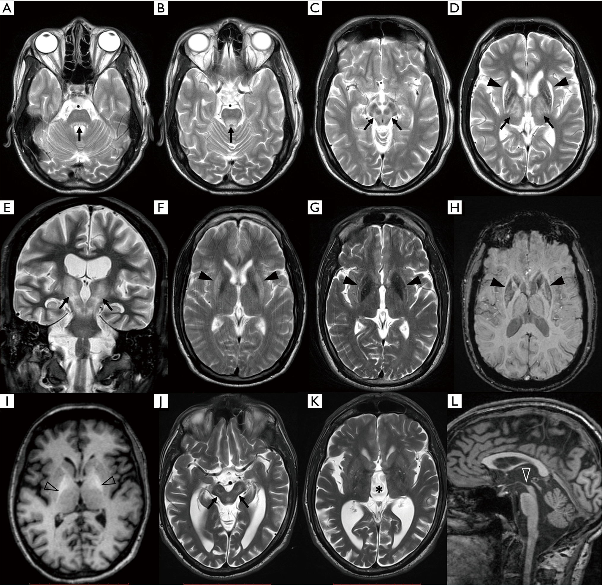 Neurologic Impairment In Wilson Disease Dusek Annals Of Translational Medicine