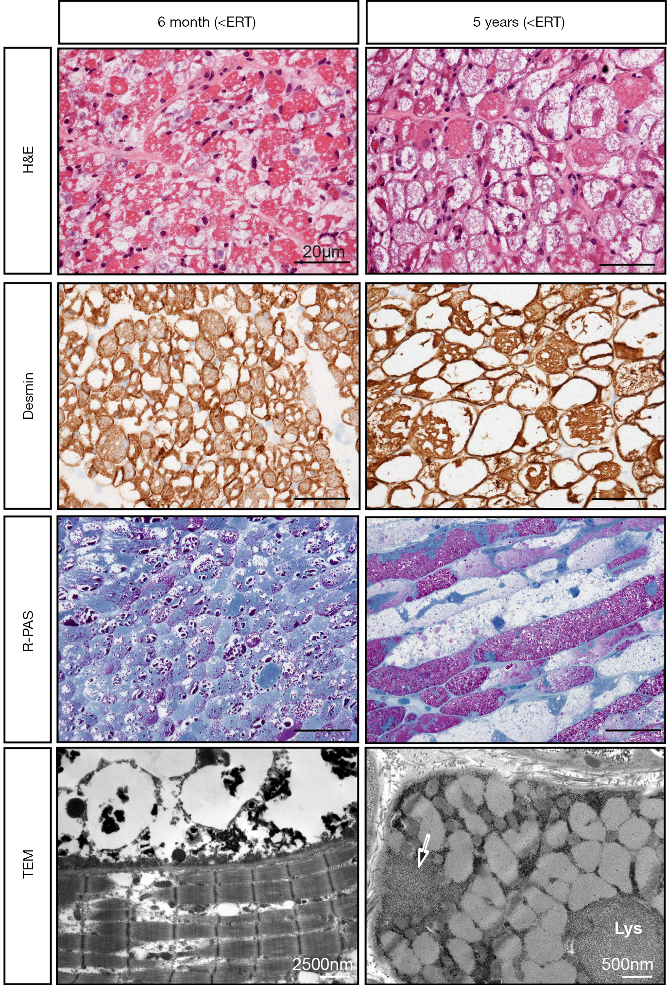 Long Term Outcome And Unmet Needs In Infantile Onset Pompe Disease Hahn Annals Of Translational Medicine