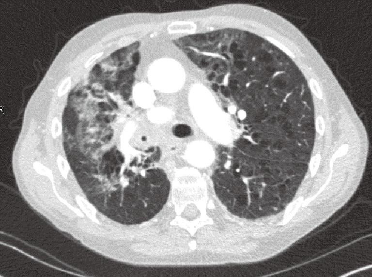 How Do I Know If I Have Lung Cancer Or Pneumonia : Atypical Pneumonia