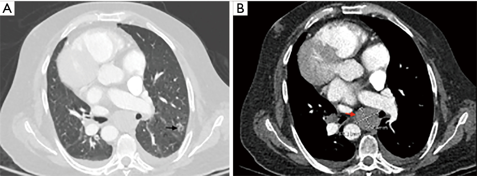 Bronchoscopic instillation of DNase to manage refractory lobar