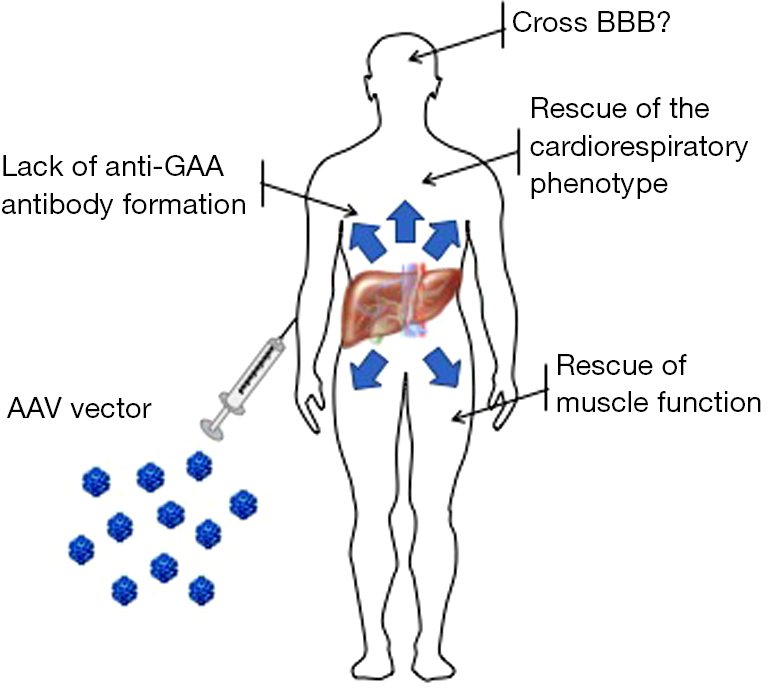 Progress And Challenges Of Gene Therapy For Pompe Disease Ronzitti Annals Of Translational Medicine