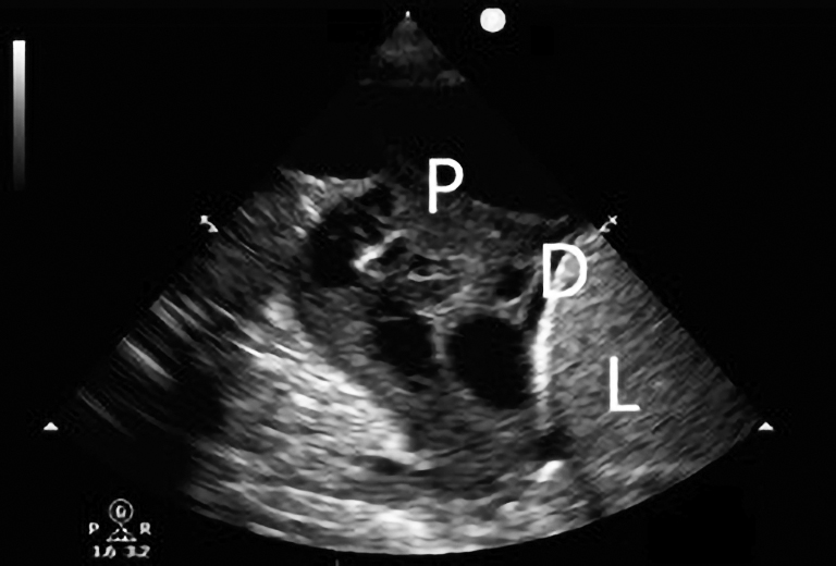 Point Of Care Ultrasound In Thoracic Malignancy Miles Annals Of Translational Medicine