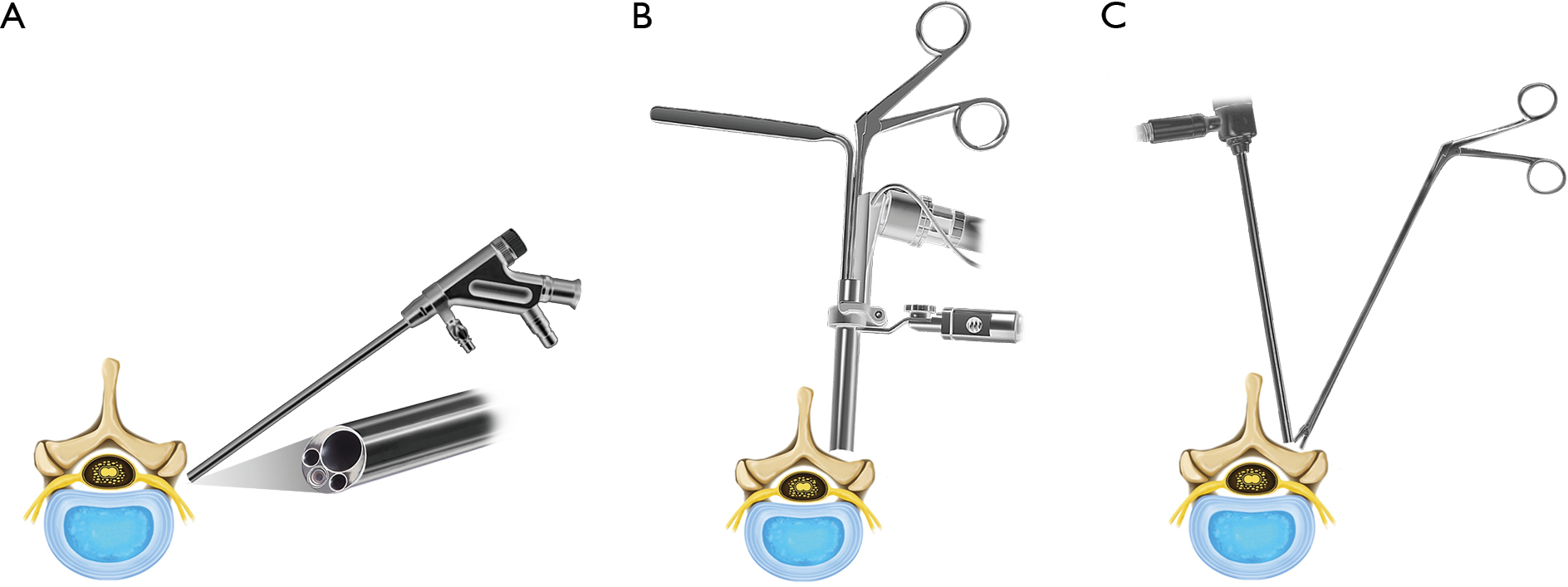 Current techniques of endoscopic in spine surgery Ahn