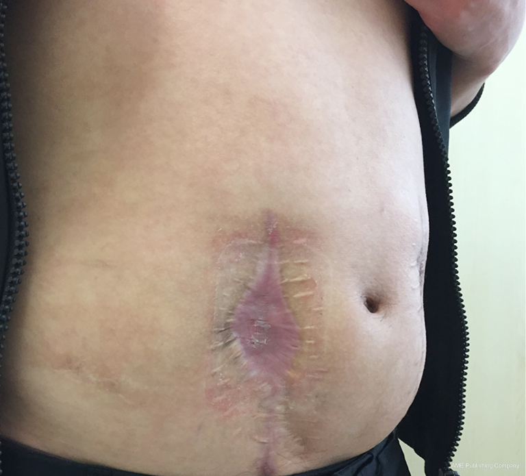 What Is A Seroma After Hernia Surgery