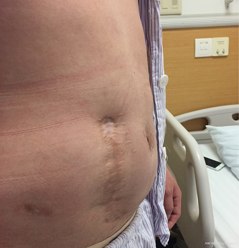 Mesh Preservation Approach To Treatment Of Mesh Infection After Large Incisional Ventral Hernia Repair How I Do It Yang Annals Of Translational Medicine