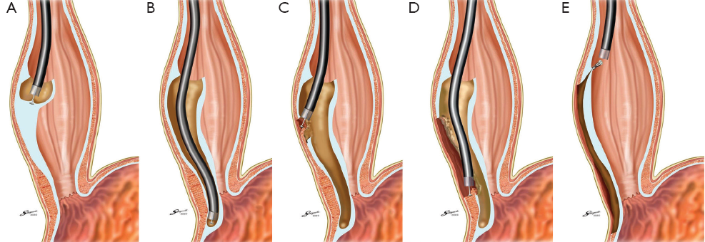 Peroral endoscopic myotomy for esophageal achalasia - Phalanusitthepha