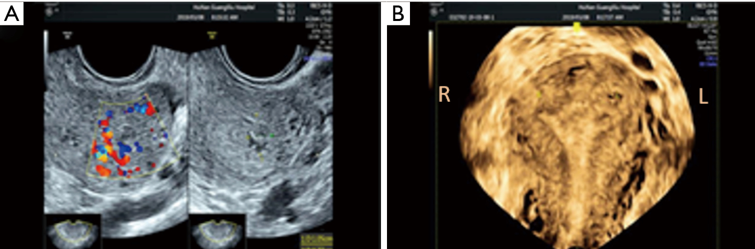 Hysteroscopic Removal Of Angular Retained Products Of Conception Hidden Behind Intrauterine Adhesions Using A 12 Fr Spoon Shaped Forceps Zhang Annals Of Translational Medicine
