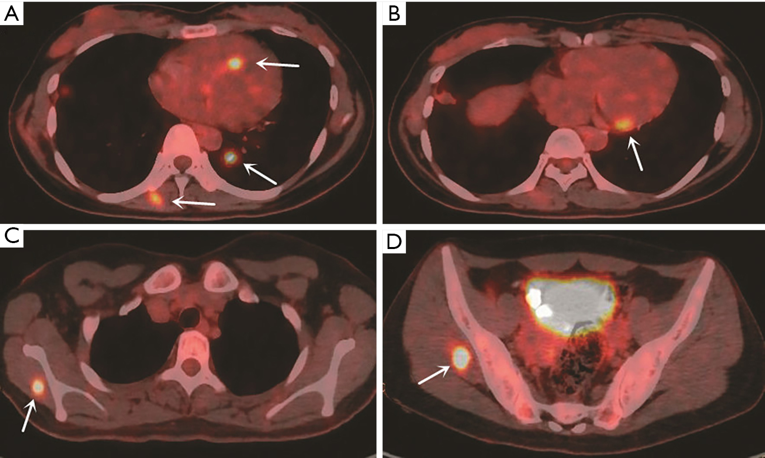Primary pulmonary epithelioid malignant peripheral nerve ...