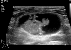 Partially cystic thyroid cancer on conventional and elastographic ultrasound: a retrospective study and a machine learning—assisted system - Zhao - Annals of Translational Medicine