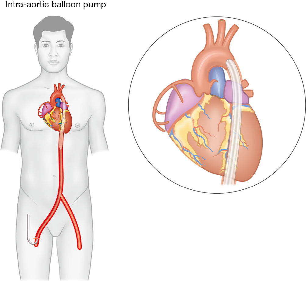 Short Term Mechanical Circulatory Support Intra Aortic Balloon Pump Impella Extracorporeal Membrane Oxygenation Tandemheart A Review Wong Annals Of Translational Medicine Only helium or co2 gas is used for balloon inflation. intra aortic balloon pump impella
