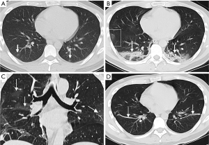 Coronavirus Disease 19 Covid 19 Chest Ct Characteristics Benefit To Early Disease Recognition And Patient Classification A Single Center Experience Zhou Annals Of Translational Medicine