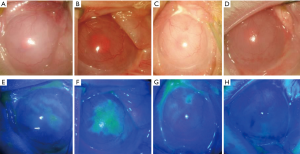 Reconstruction of the ocular surface by autologous transplantation