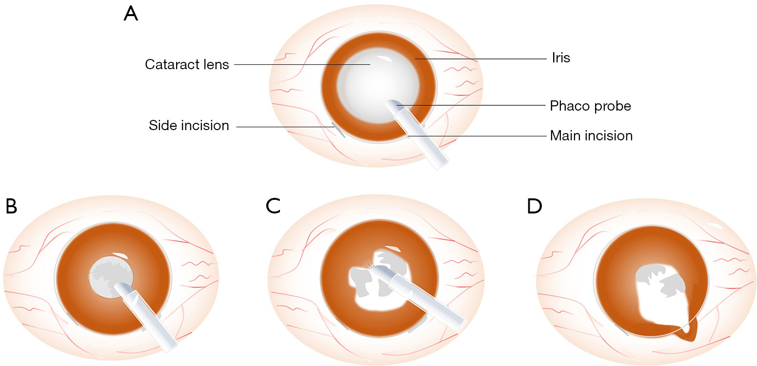 Floppy iris syndrome что это