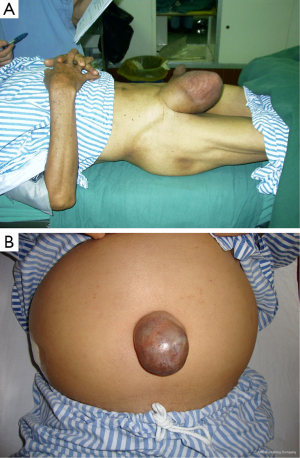 Umbilical Hernia Causes and Treatment, by Kristensmith Taylor