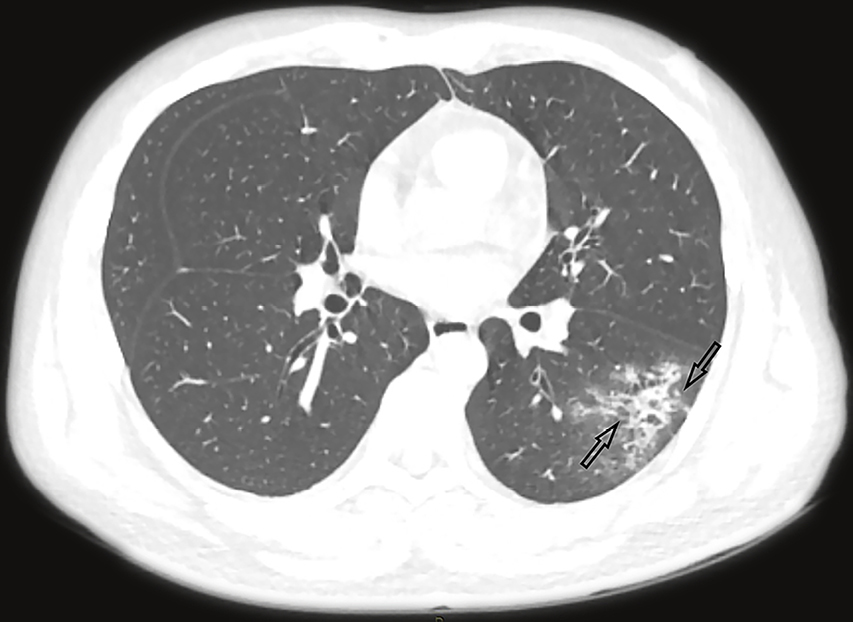 High resolution computed tomography for the diagnosis of ...
