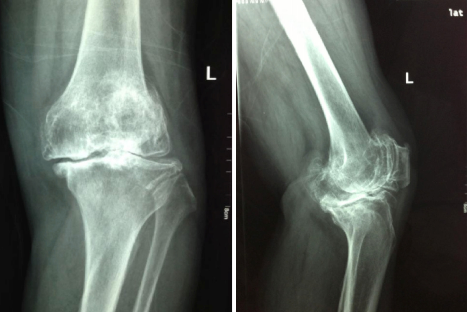 Сустав 1а. Гонартроз коленного сустава рентген. Деформирующий гонартроз коленного сустава. Гонартроз 2 степени коленного сустава рентген. Гонартроз коленного сустава 1 степени на рентгене.