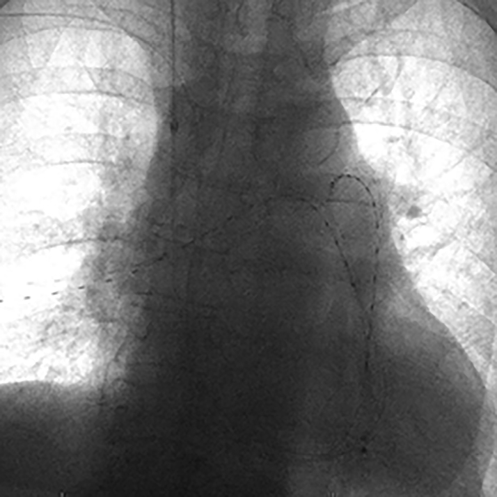 Catheterdirected interventions for pulmonary embolism Zarghouni