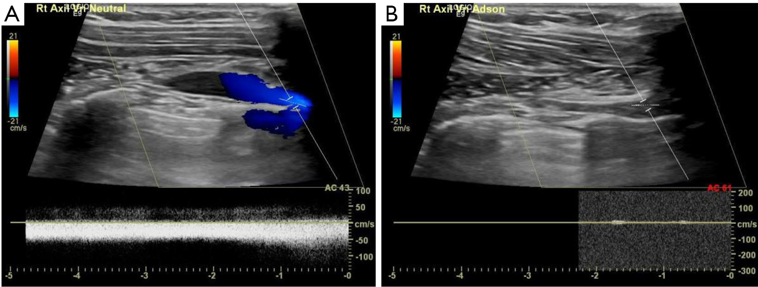 Paget Schroetter Syndrome Treatment Of Venous Thrombosis And Outcomes Hangge Cardiovascular Diagnosis And Therapy