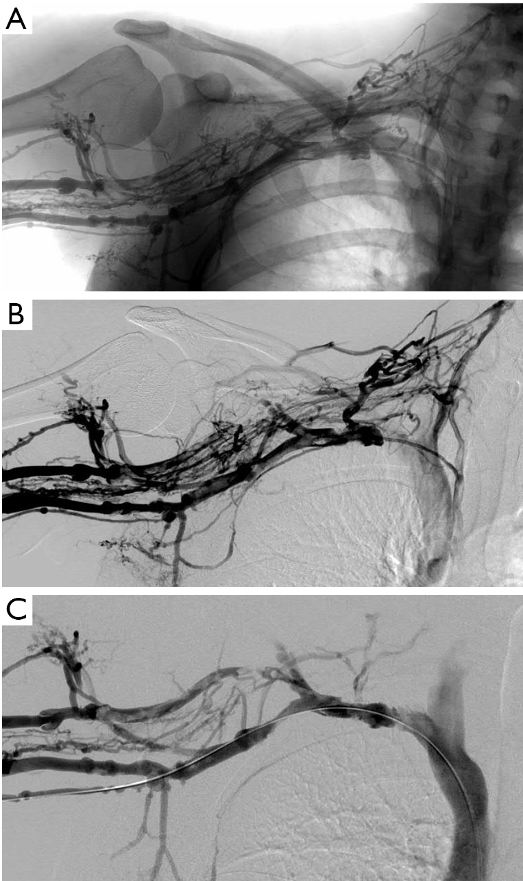 Paget Schroetter Syndrome Treatment Of Venous Thrombosis And Outcomes Hangge Cardiovascular Diagnosis And Therapy