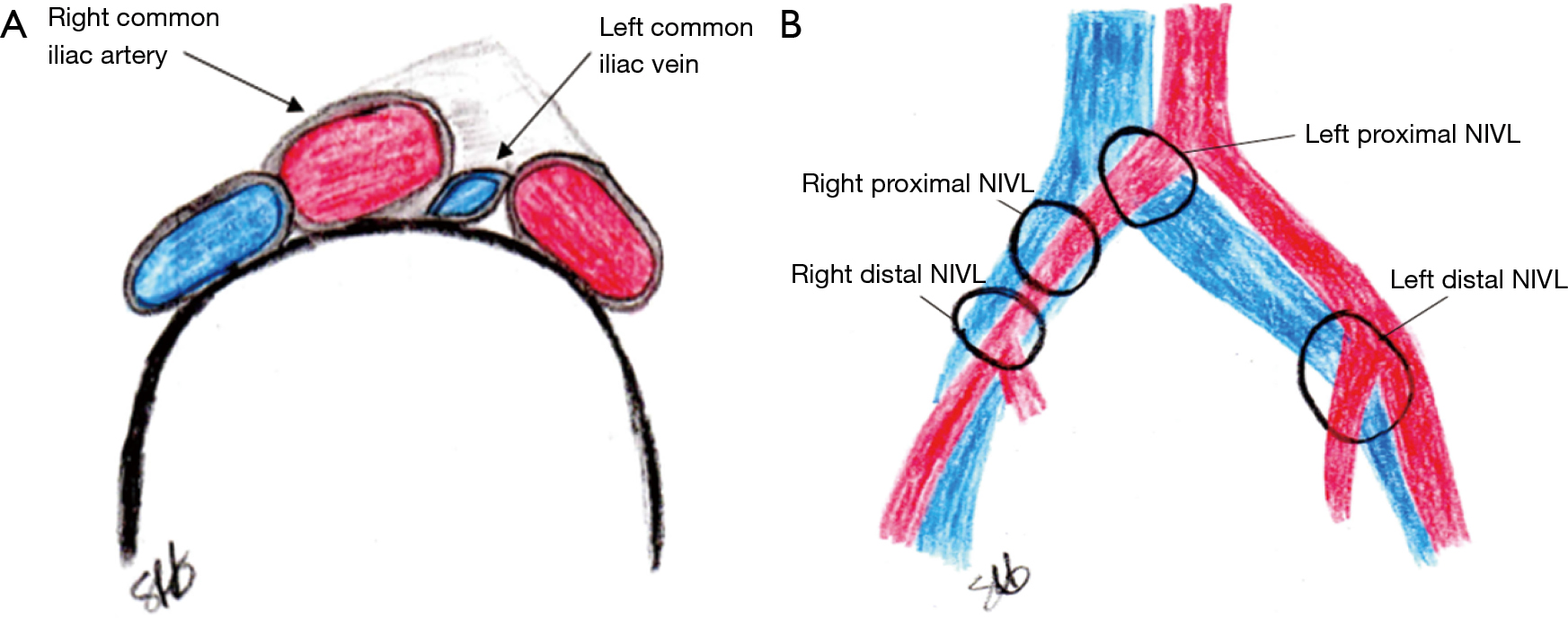 Re-intervention for occluded iliac vein stents - Black - Cardiovascular Diagnosis and Therapy Re-intervention for occluded iliac vein stents - Black - Cardiovascular Diagnosis and Therapy