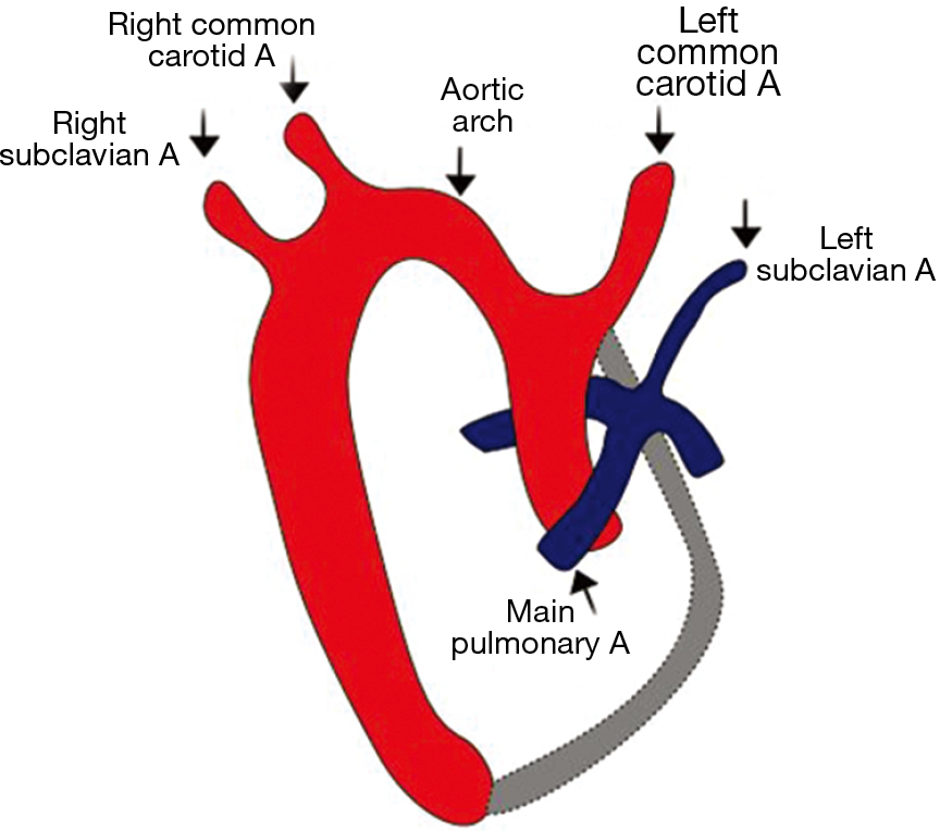 Congenital Anomalies Of The Aortic Arch Priya Cardiovascular Diagnosis And Therapy