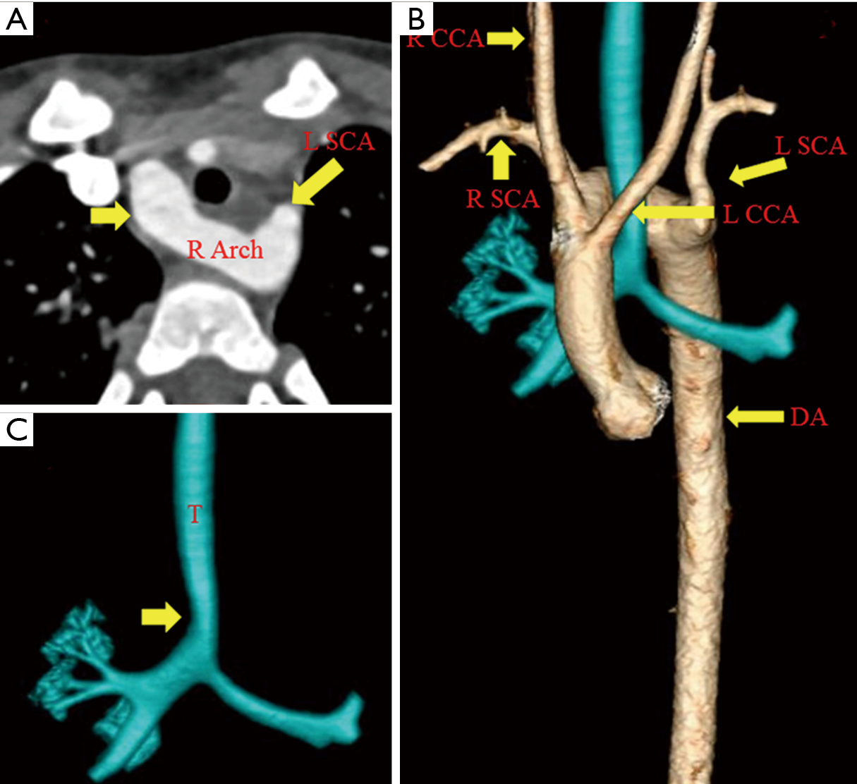Congenital Anomalies Of The Aortic Arch Priya Cardiovascular Diagnosis And Therapy