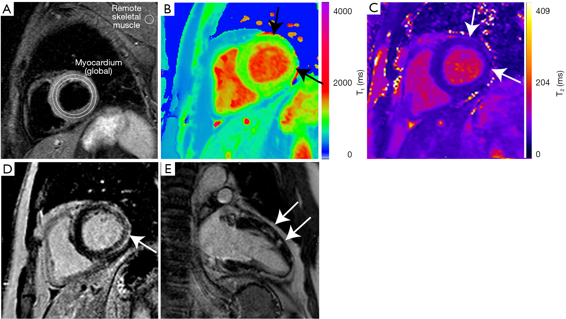 Cardiovascular Magnetic Resonance Imaging For Inflammatory Heart Diseases Lewis Cardiovascular Diagnosis And Therapy