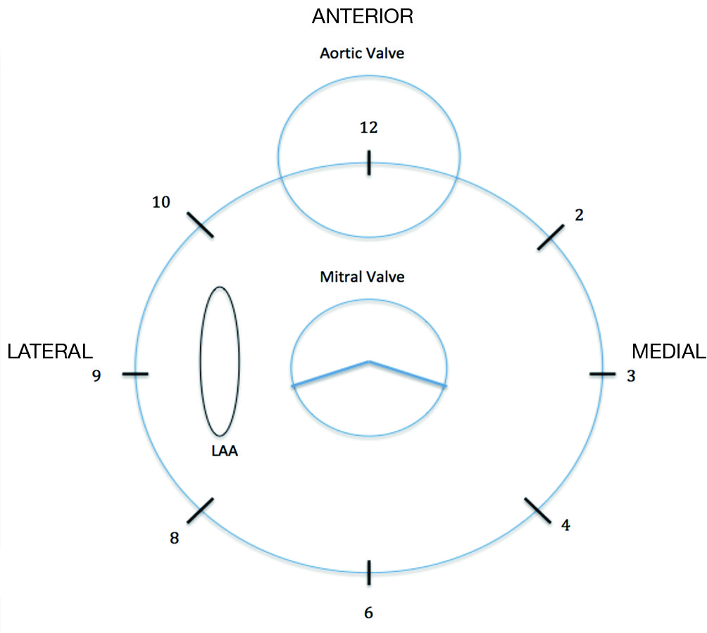 Cardiac Imaging In Prosthetic Paravalvular Leaks Lazaro Cardiovascular Diagnosis And Therapy The valve is leaky (aortic insufficiency, also known as aortic regurgitation). prosthetic paravalvular leaks