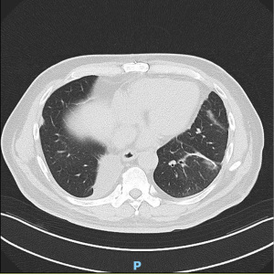 Video-assisted thoracoscopic left S8 segmentectomy guided by Video-assisted thoracoscopic left S8 segmentectomy guided by