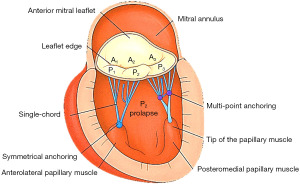 Endoscopic mitral valve repair—one hundred and one ways to