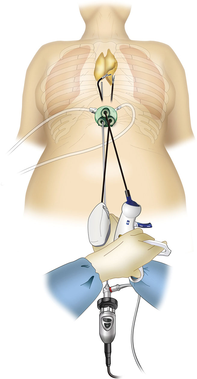 Subxiphoid thymectomy singleport, dualport, and robotassisted
