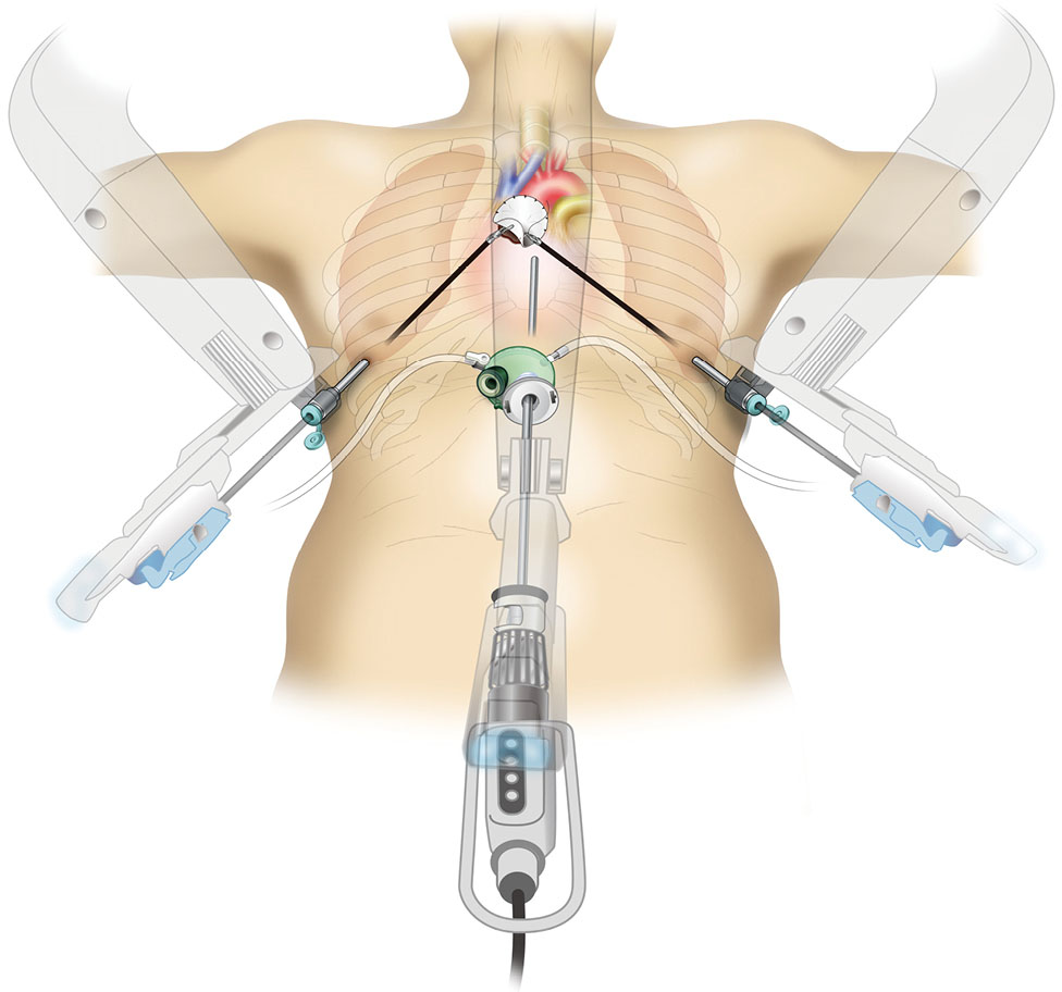 Subxiphoid thymectomy singleport, dualport, and robotassisted