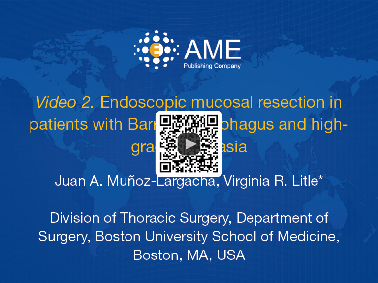 Endoscopic mucosal ablation and resection of Barrett’s esophagus and
