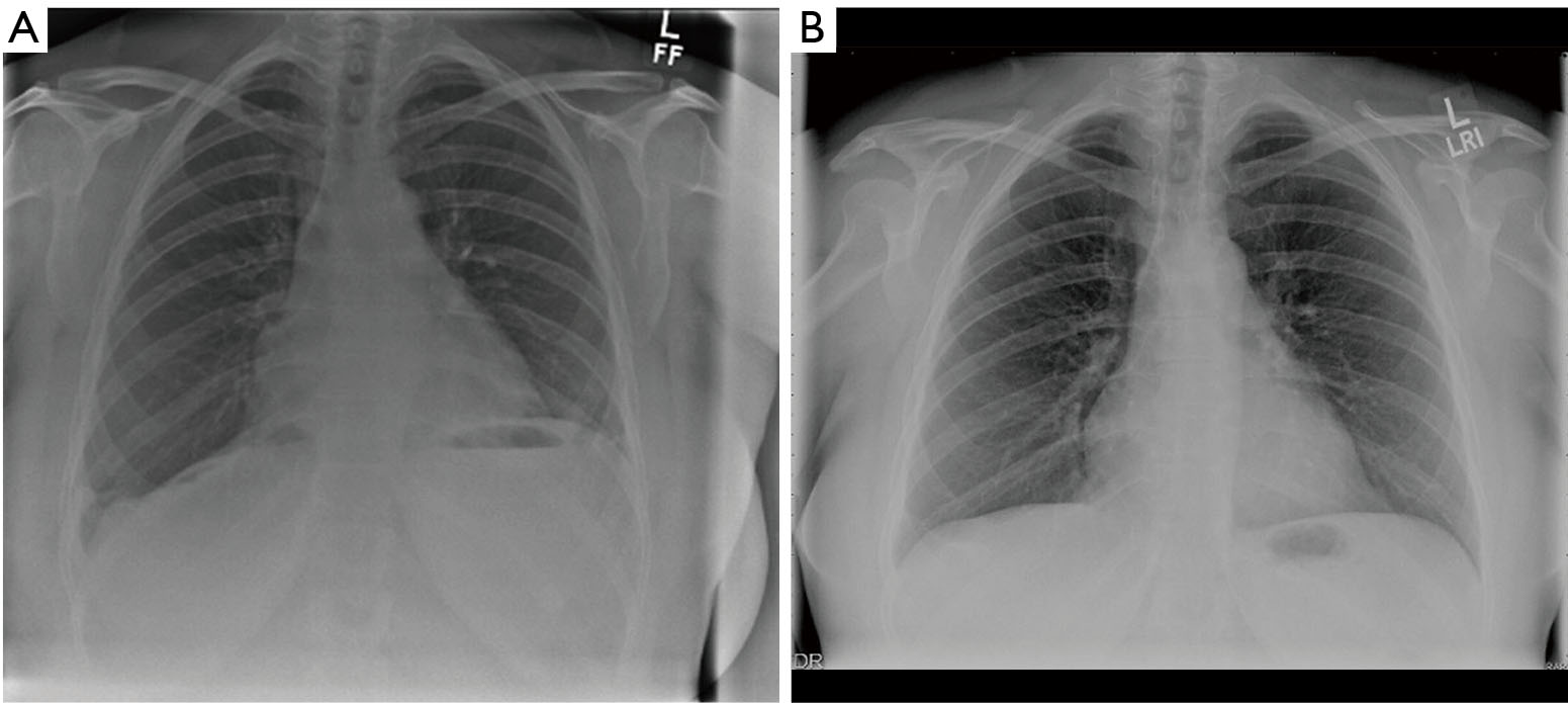 Thoracoscopic approach to congenital diaphragmatic hernias in adults: Southampton approach and review of the literature - Amer - Journal of Visualized Surgery Thoracoscopic approach to congenital diaphragmatic hernias in adults: Southampton approach and review of the literature - Amer - Journal of Visualized Surgery