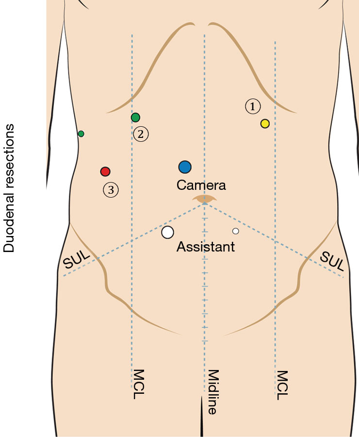 Minimally Invasive Resection Of Duodenal Tumors Cervoni Journal Of Visualized Surgery