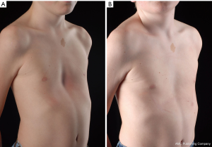 Non-Surgical Treatment Of Pectus Excavatum - Haecker - Journal Of  Visualized Surgery