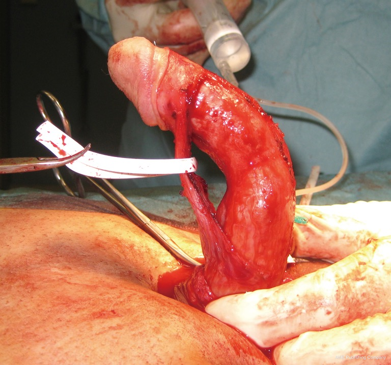 Peyronie\u2019s graft surgery\u2014tips and tricks from the masters in andrologic surgery ...