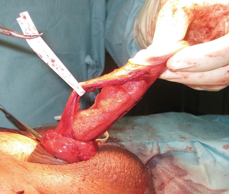 Peyronie S Graft Surgery Tips And Tricks From The Masters In Andrologic Surgery Hatzichristodoulou Translational Andrology And Urology