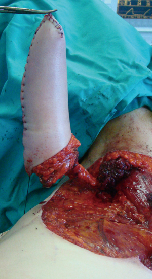 Novel surgical techniques in female to male gender confirming surgery - Djordjevic - Translational Andrology and Urology Novel surgical techniques in female to male gender confirming surgery - Djordjevic - Translational Andrology and Urology
