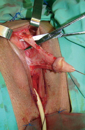 Novel surgical techniques in female to male gender confirming surgery - Djordjevic - Translational Andrology and Urology Novel surgical techniques in female to male gender confirming surgery - Djordjevic - Translational Andrology and Urology