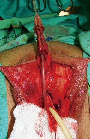 Novel surgical techniques in female to male gender confirming surgery - Djordjevic - Translational Andrology and Urology Novel surgical techniques in female to male gender confirming surgery - Djordjevic - Translational Andrology and Urology