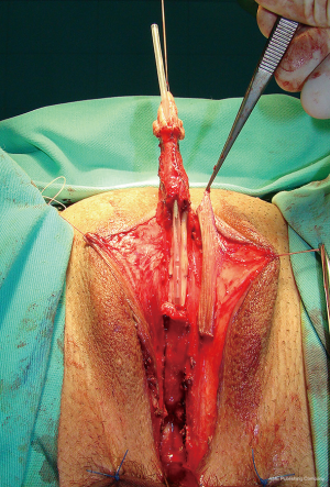 Novel surgical techniques in female to male gender confirming surgery - Djordjevic - Translational Andrology and Urology Novel surgical techniques in female to male gender confirming surgery - Djordjevic - Translational Andrology and Urology