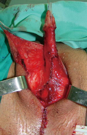 Novel surgical techniques in female to male gender confirming surgery - Djordjevic - Translational Andrology and Urology Novel surgical techniques in female to male gender confirming surgery - Djordjevic - Translational Andrology and Urology