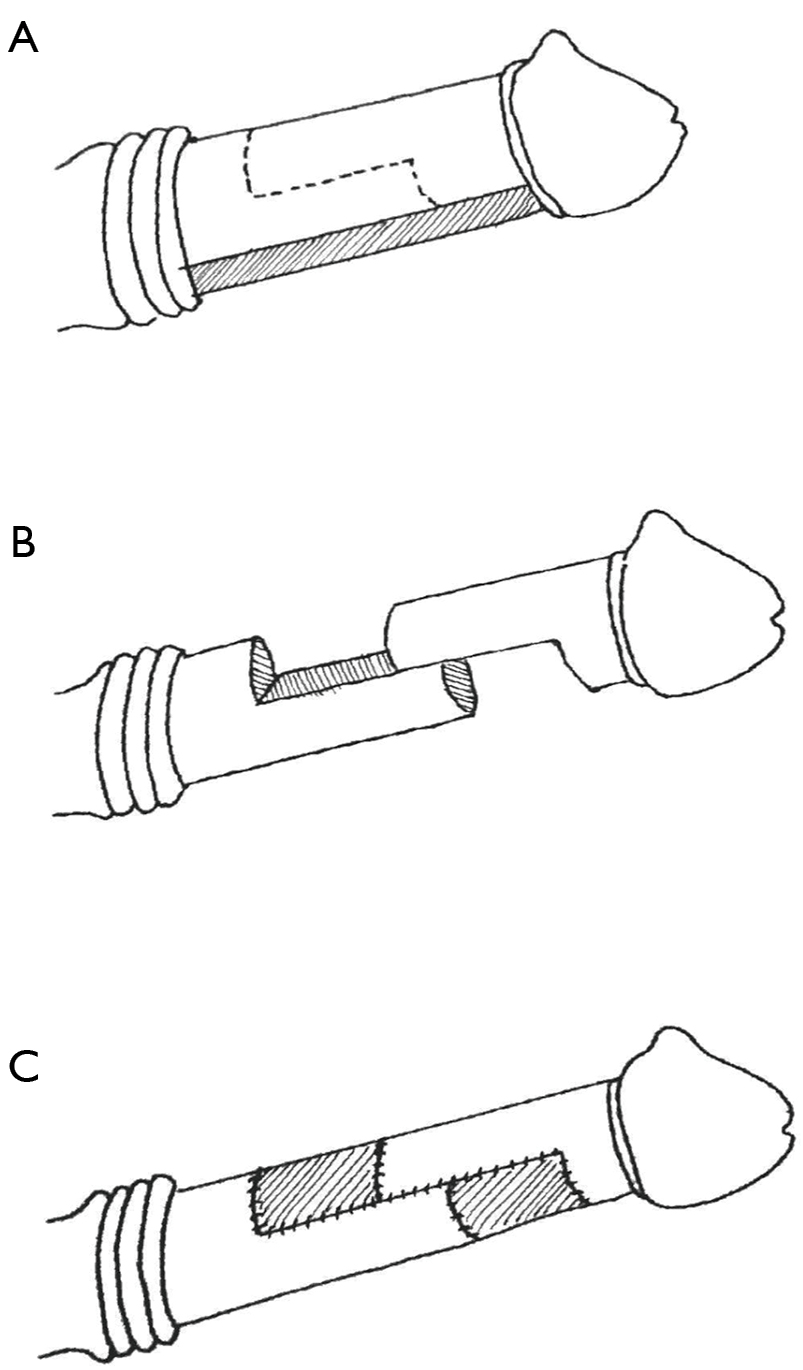Contemporary Surgical And Non Surgical Management Of Peyronie S Disease Wayne Translational Andrology And Urology