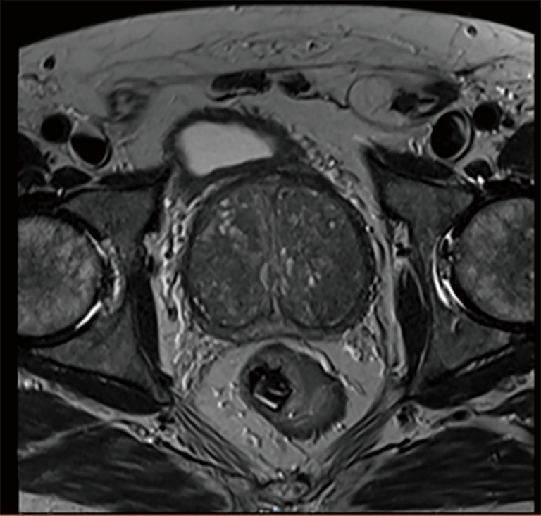 Prostate Imaging Features That Indicate Benign Or Malignant Pathology On Biopsy Lovegrove Translational Andrology And Urology