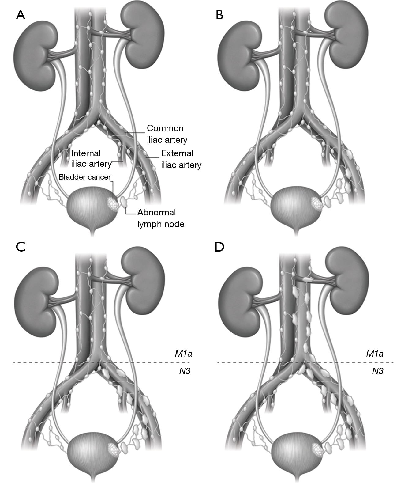 A Pictorial Review Of Bladder Cancer Nodal Metastases Shankar Translational Andrology And Urology