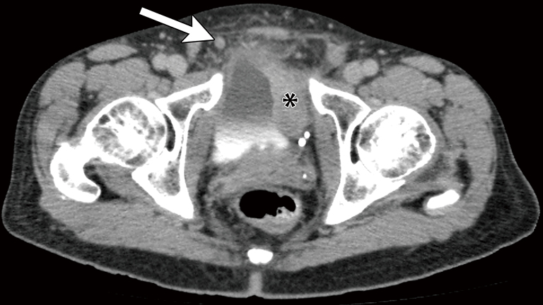 A Pictorial Review Of Bladder Cancer Nodal Metastases Shankar Translational Andrology And Urology