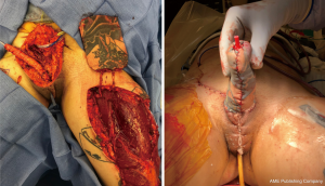 phalloplasty before and after ftm