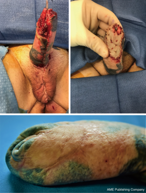 phalloplasty before and after ftm